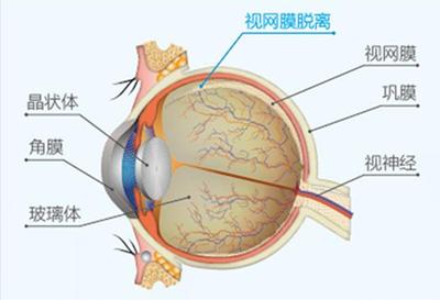 一旦发现有视网膜裂孔,应立即激光治疗封闭裂孔,避免发展到视网膜脱离